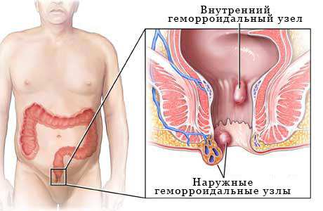 геморрой